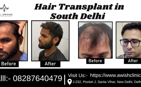 Hair Transplant in South Delhi Top Clinics, Cost & Real Results (2025 Guide)