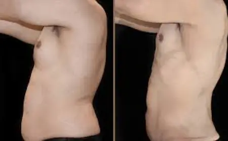 How to Maintain Results After Vaser 4D Liposuction?