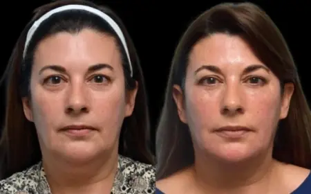 How to Choose the Right Clinic for Dark Circles Treatment in Dubai