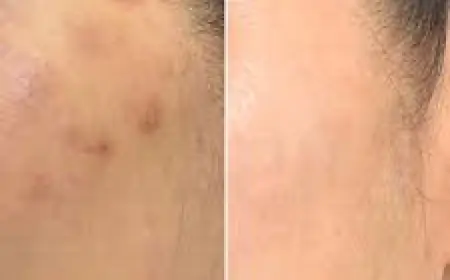 Pico Laser Treatment in Islamabad: The Smart Choice for Flawless Skin