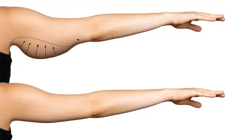 Before and After Results of Arm Contouring Surgery