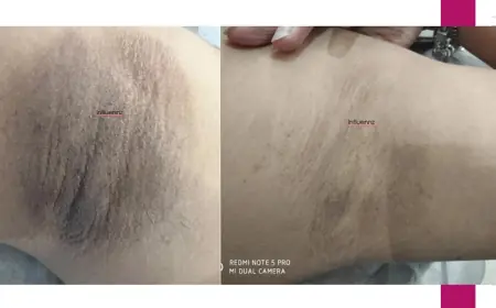 Dark Underarms Treatment: Causes, Solutions & What to Expect