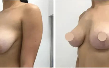 Personalized Breast Lift Consultations in Dubai