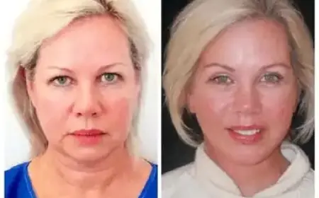 Reveal Refined Beauty through Profhilo Treatments in Dubai