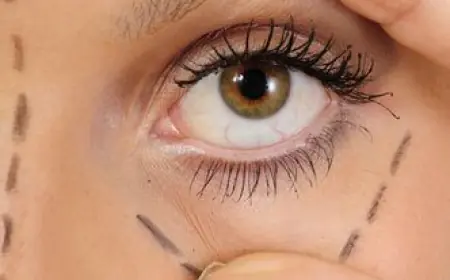 الفرق بين جراحة رأب الجفن الجفني والعلوي والبيني