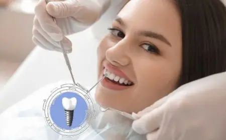 Dental Implants That Feel Like Your Own in Bournemouth
