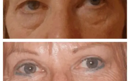 How the Best Doctors in Dubai Tailor Eye Bag Removal to Each Face Shape