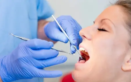 Can You Get a Cavity Under a Filling? Understanding Secondary Decay