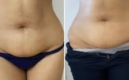 What It Feels Like to Get Fat Melting Injections?