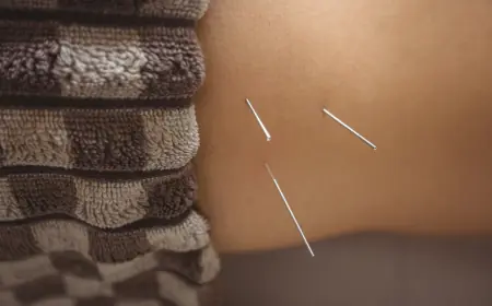 Chronic Pain, Meet Your Match: How Acupuncture Offers Lasting Relief in Phoenix, Arizona