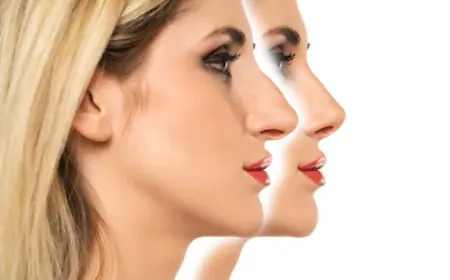 Alarplasty in Riyadh: Patient Stories and Before & After Photos