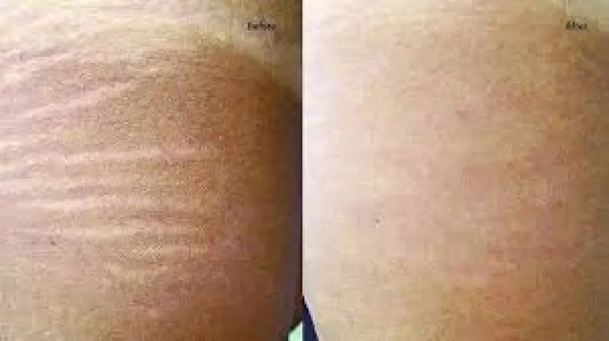 Stretch Mark Removal in Bangalore: Real Results Without the Stress