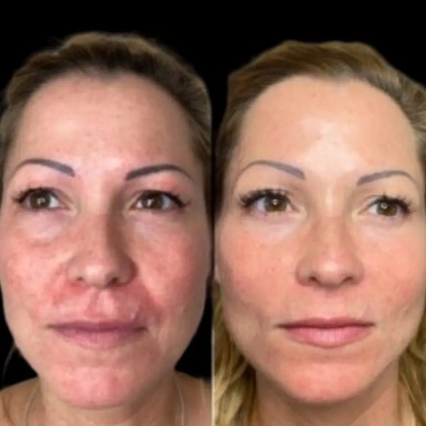 Direct Radiance through Profhilo Treatment in Dubai