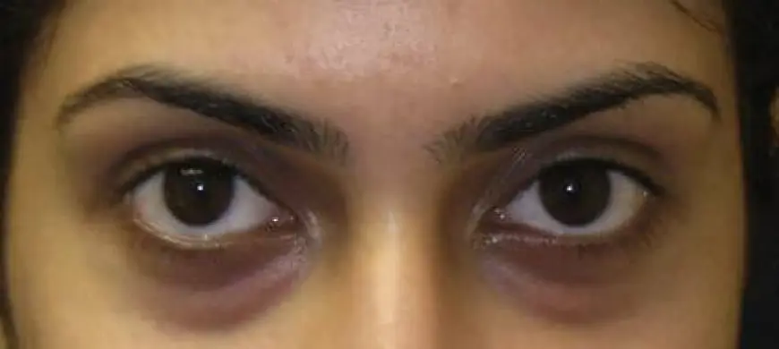 How Do Dark Circles Treatments Work?
