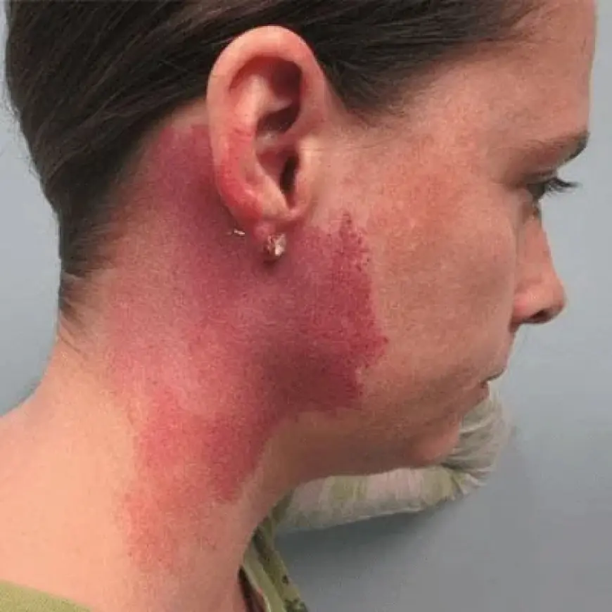 Can Port Wine Stains Be Permanently Removed?