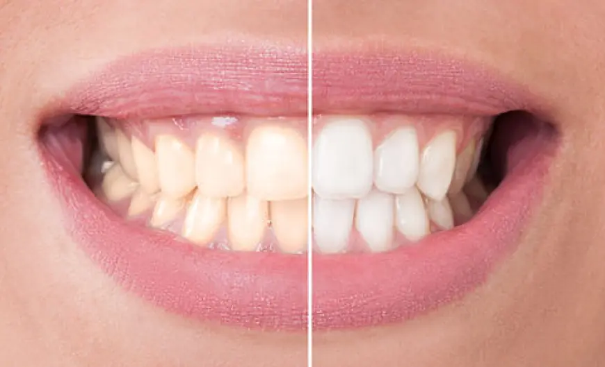 Can You Get Professional Teeth Whitening with Braces On?