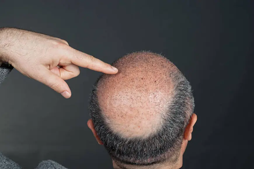 FUE Hair Transplant: Your Guide to Restoring Hair Naturally