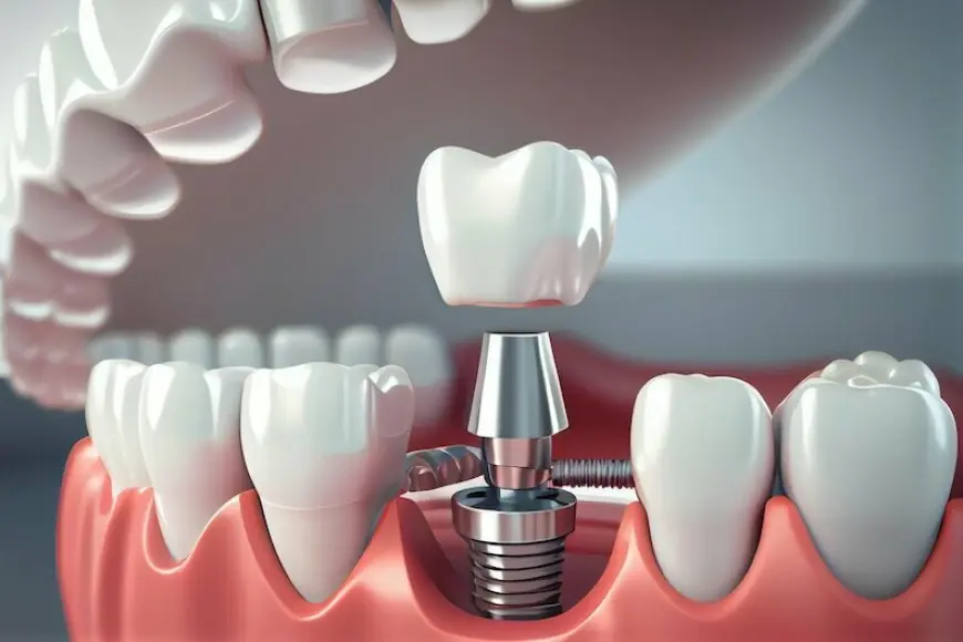 Dental Implants: Restoring Confidence One Tooth At A Time