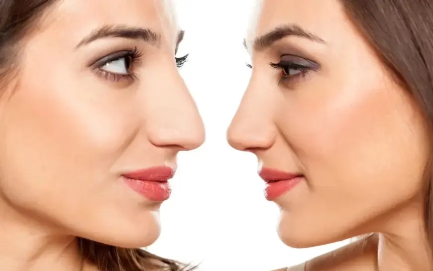 Reveal the Best Version with Non-Surgical Nose Job in Dubai