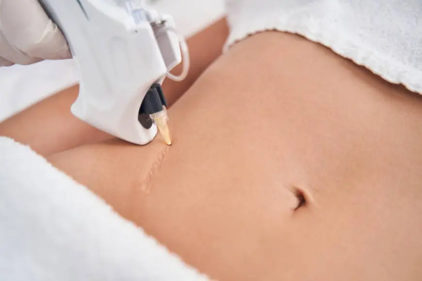 Burn Scar Removal in Dubai: Restore Your Skin’s Natural Beauty