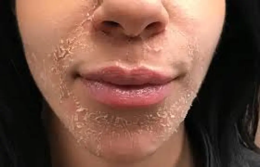 How Do I Know If My Skin Is Ready for a Peel?