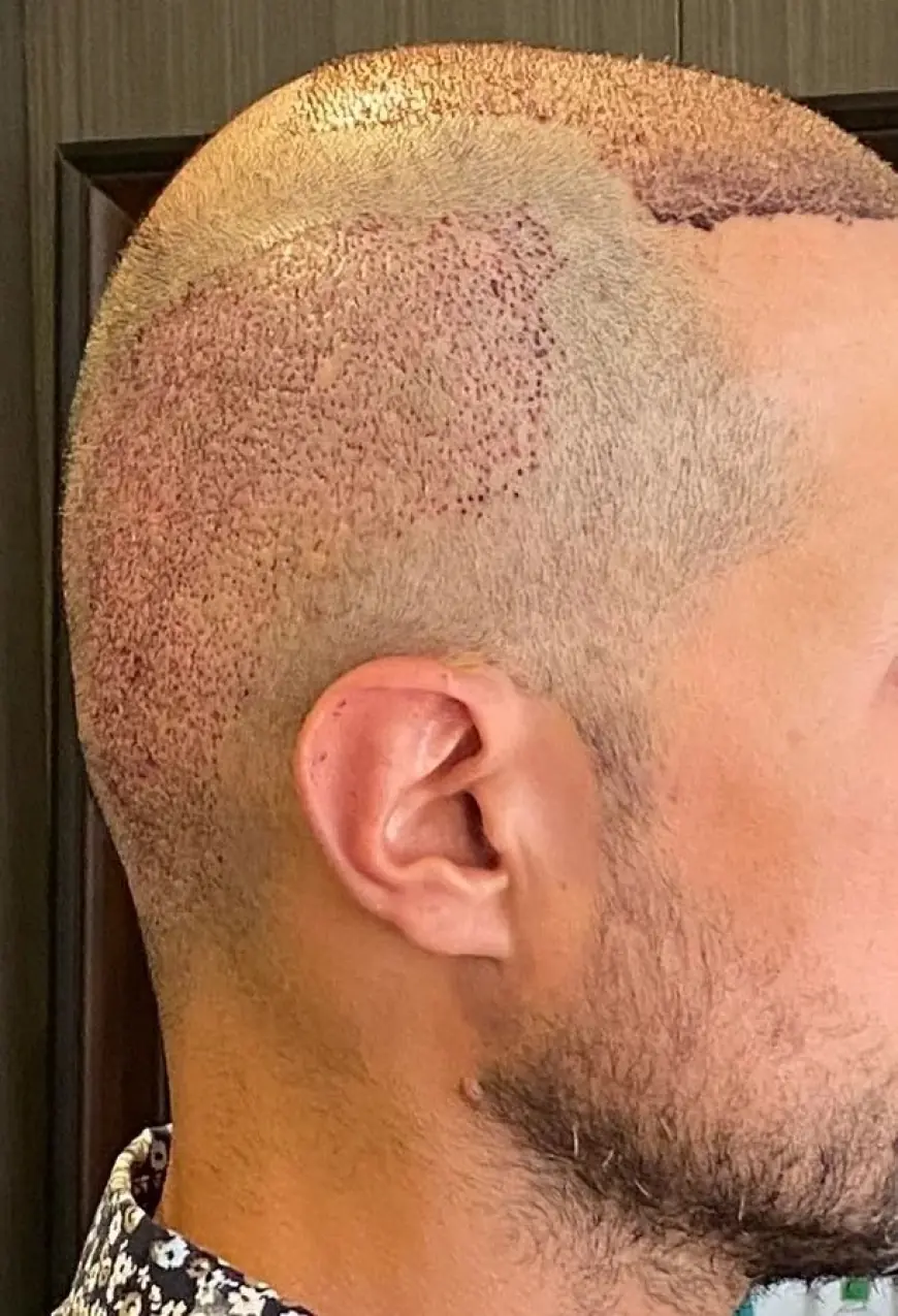 Crown Hair Transplant in Dubai: A Complete Guide