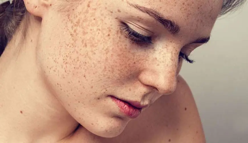 Benefits of Microneedling for Melasma Treatment in Islamabad