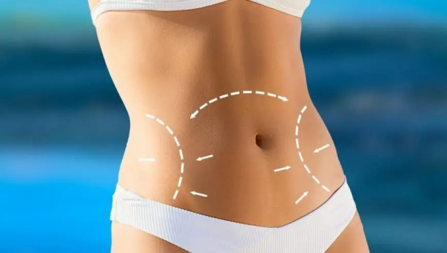 Understanding Liposuction: Myths vs. Facts in Islamabad