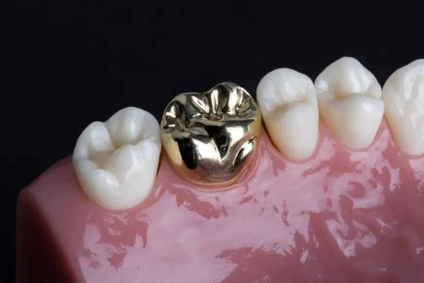 What to Expect After Getting a Dental Crown or Bridge in Islamabad