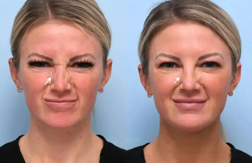 Why Botox Treatments in Dubai Are Popular Among Expats