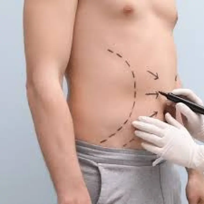 Liposuction in Islamabad – A Safe and Effective Body Contouring Option