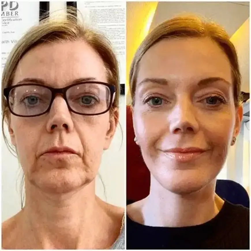 Harness Smoothness through Profhilo in Dubai