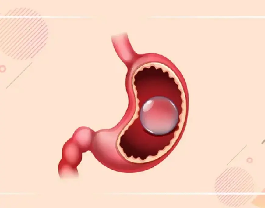 Choosing a Gastric Balloon Type in Riyadh: Your Guide to Weight Loss Options