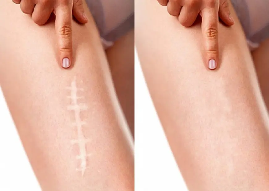 Affordable Scar Removal in Dubai: Quality Care Within Reach
