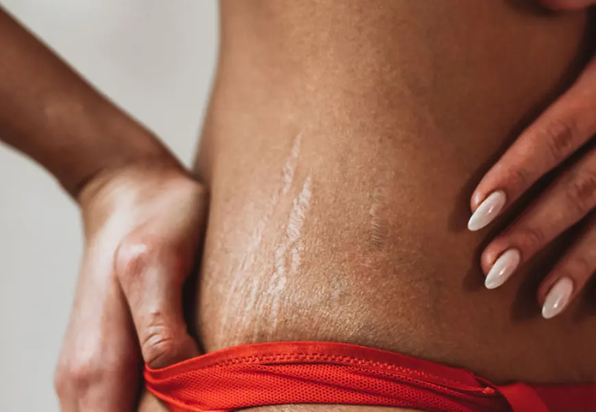 Stretch Marks Removal: Quick Fix or Long Term Plan