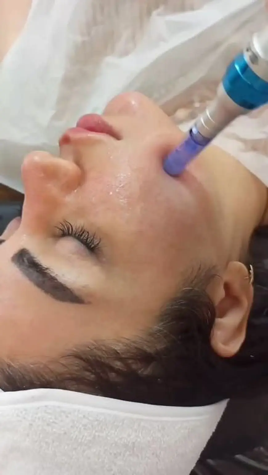 Derma Pen for Melasma – Does It Help?