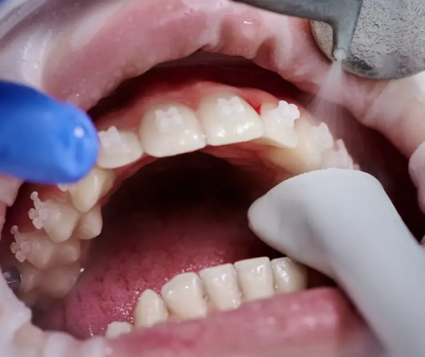 Common Myths About Teeth Polishing and Scaling Debunked