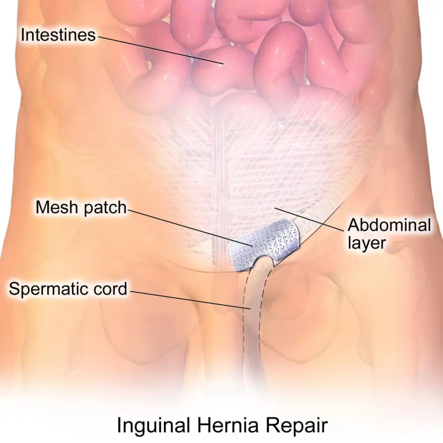 Consulting a Hernia Repair Specialist Singapore: Step-by-Step Treatment Journey