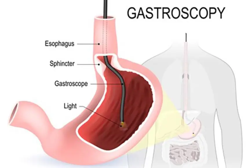 Preparing for a Gastroscopy in Singapore: Diet, Risks & FAQs