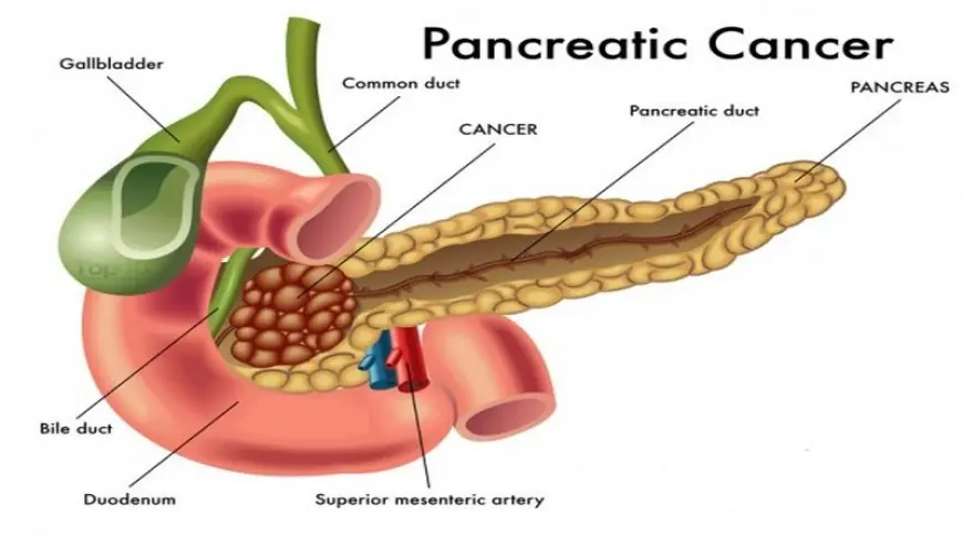 Early Signs of Pancreatic Cancer Singapore Patients Should Watch For