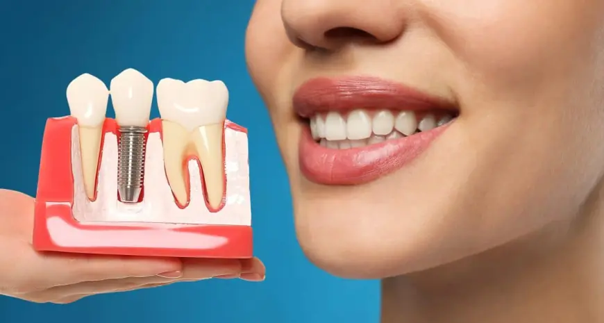 Get Ready to Shine Bright with Dental Implants Dubai Today