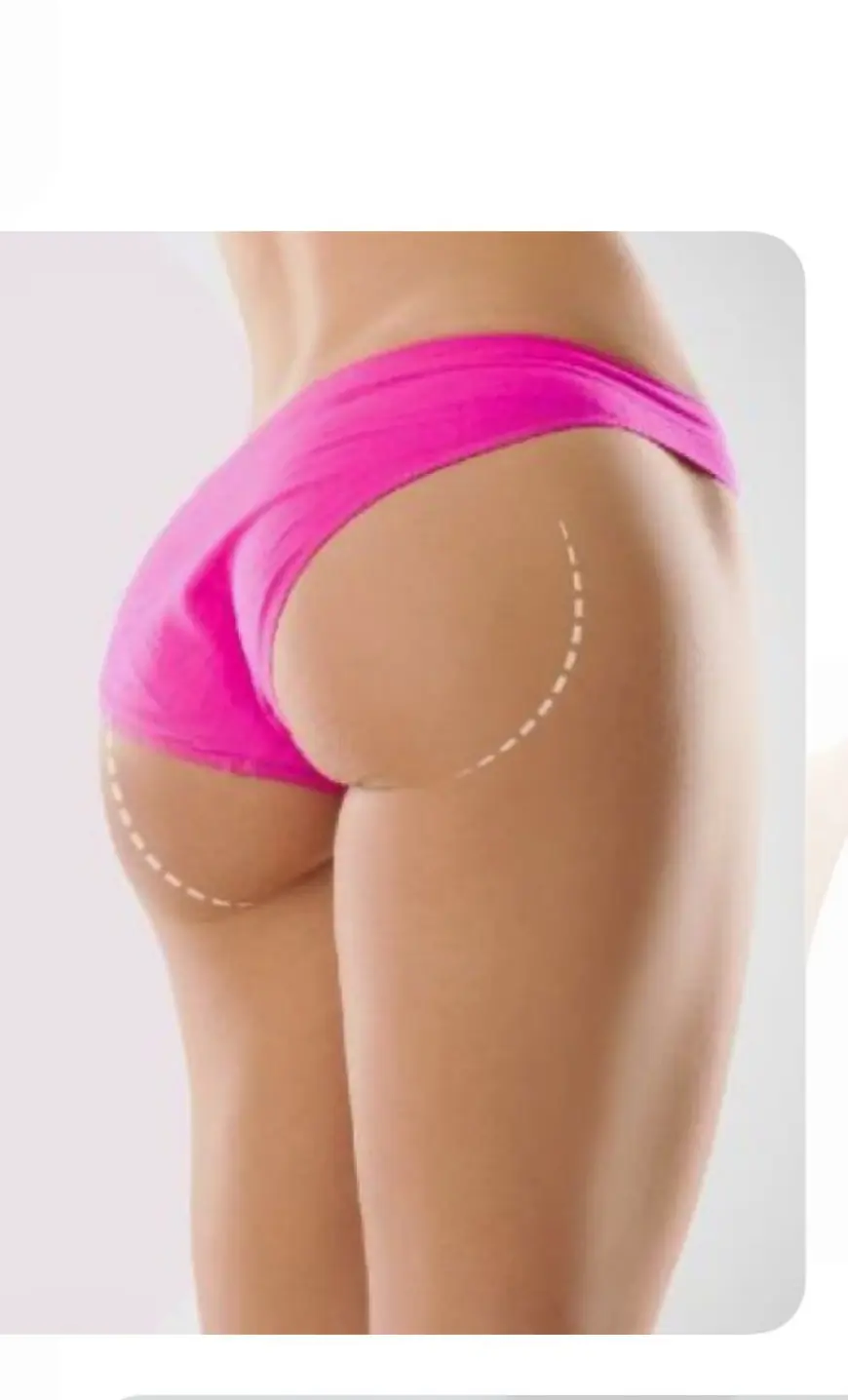Is Thigh Lift Surgery Permanent? Understanding Long-Term Results in Riyadh