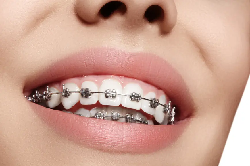 Braces and Confidence: How Orthodontics Can Transform Your Life