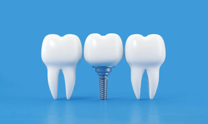 How to Care for Your Dental Implants: Daily Tips for Longevity