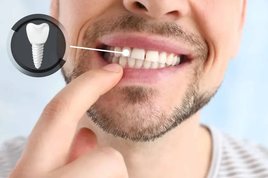Stay Fresh and Fierce with Dental Implants Dubai
