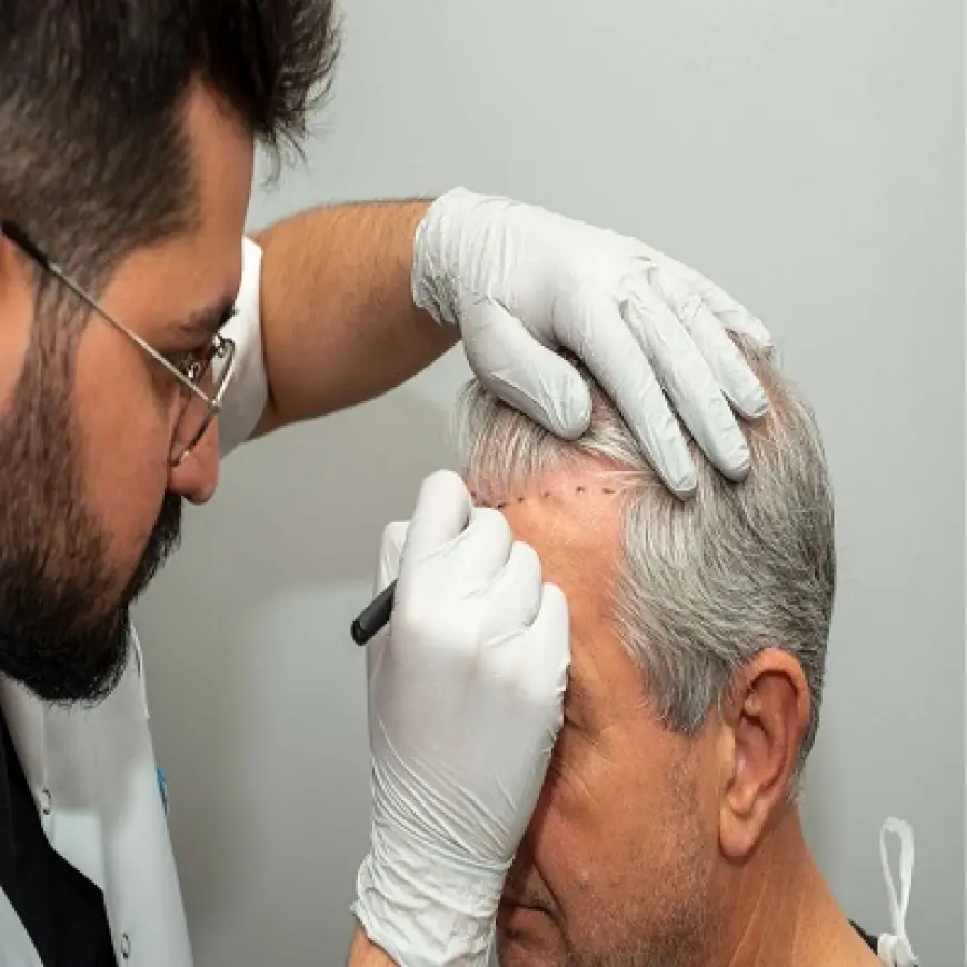 How Many Grafts Will I Need for My Hair Transplant in Islamabad?