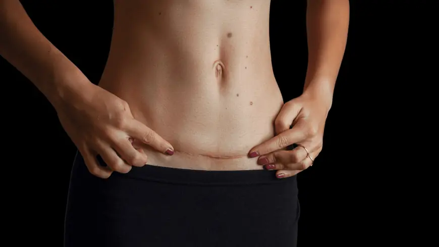 Can You Combine Abdominoplasty with Liposuction in Islamabad?