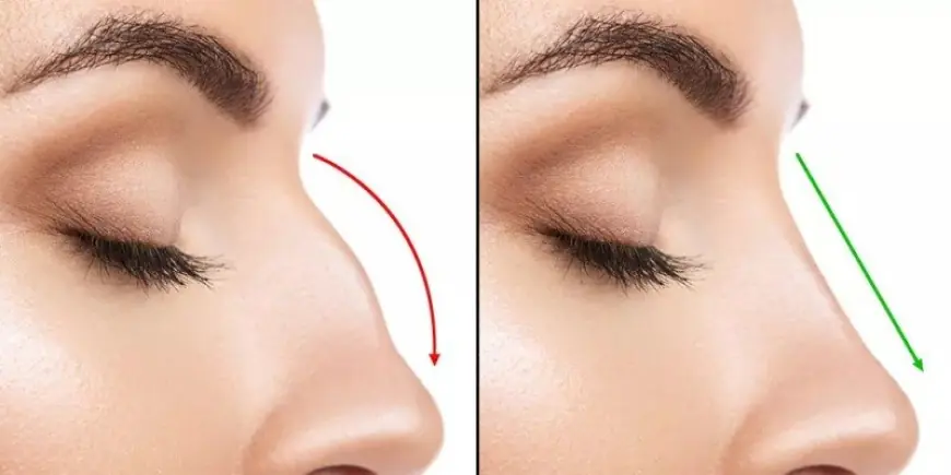 How Rhinoplasty in Dubai Can Boost Your Confidence