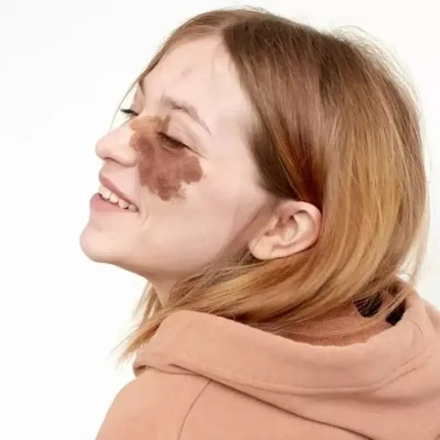 Can Laser Treatment Remove Birthmarks Permanently?