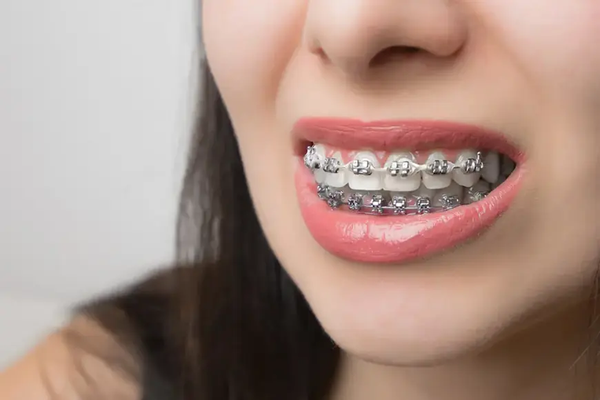 The Role of Orthodontists in Metal Braces Treatment